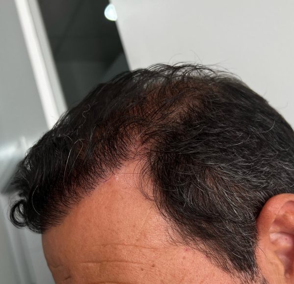 Resultado injerto capilar