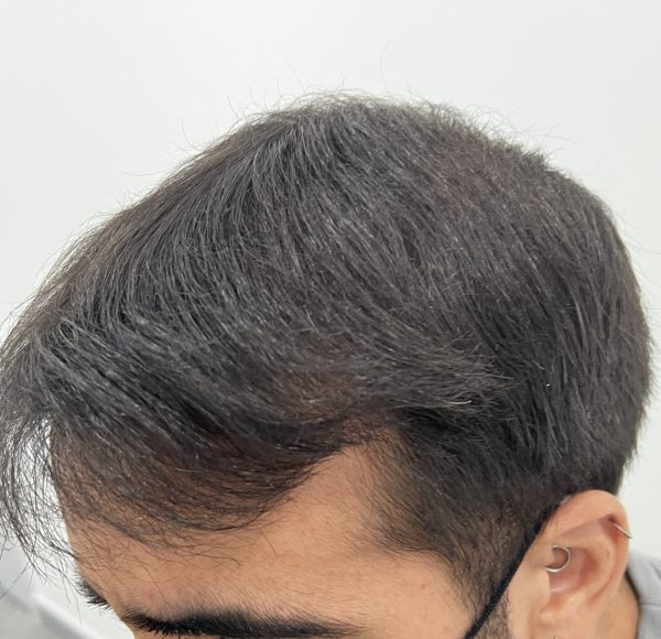 resultado injerto capilar Tecnica FUE