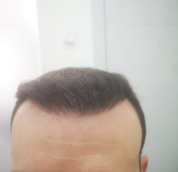 antes-despues-injerto-capilar-doctor-ever-estrada-08