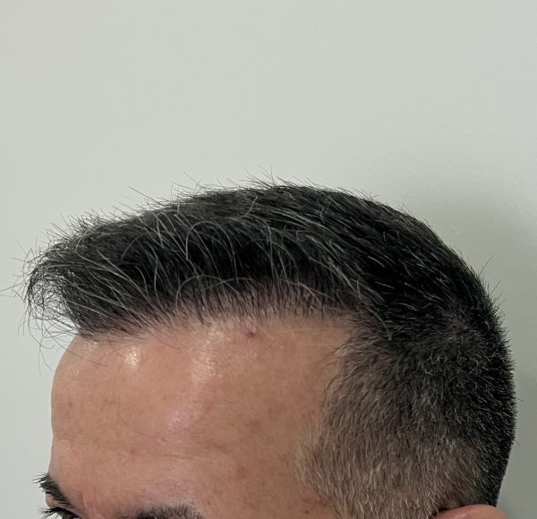Resultado cirugia capilar